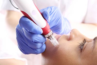 Gesichtsbehandlung Micro-Needling