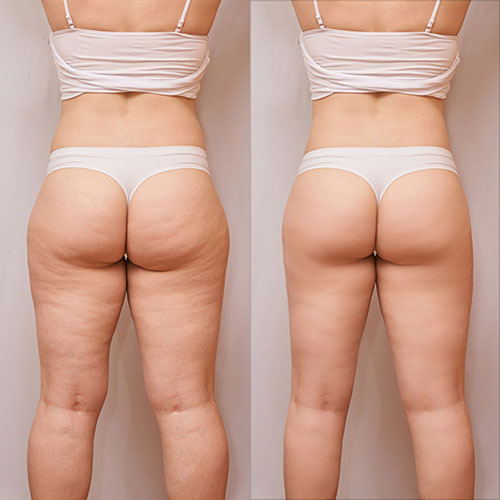 cellulite massage